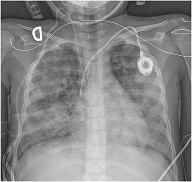 Case Report: Severe ARDS in a Pediatric Hematopoietic Stem-Cell Transplantation Recipient Caused by Disseminated Toxoplasmosis